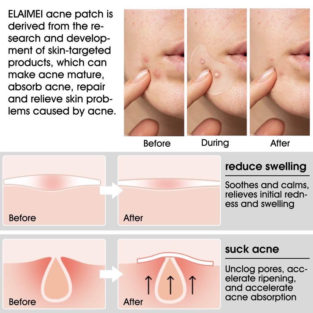 Adeus Acne! 20 Patches Hidrocoloides Foreverlily