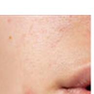 Adeus Acne! 20 Patches Hidrocoloides Foreverlily - imagem 1