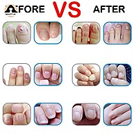 Caneta Antifúngica para Unhas — Tratamento Natural e Prático - imagem 1